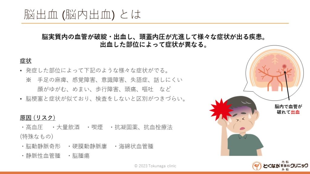 脳出血 のイメージ画像